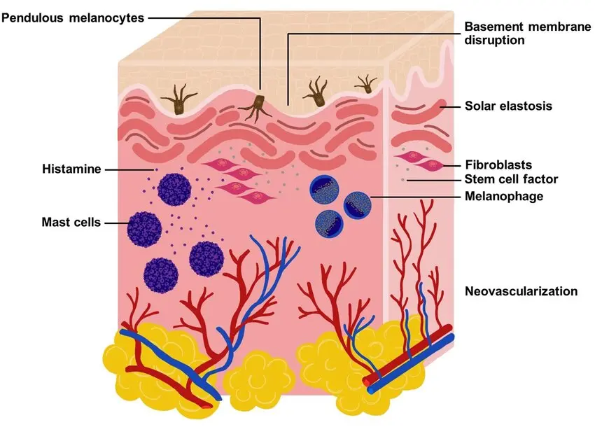 Diagram showing pathological changes in the dermis of lesional melasma, including increased blood vessels, inflammation, melanocyte activity, and altered collagen structure.