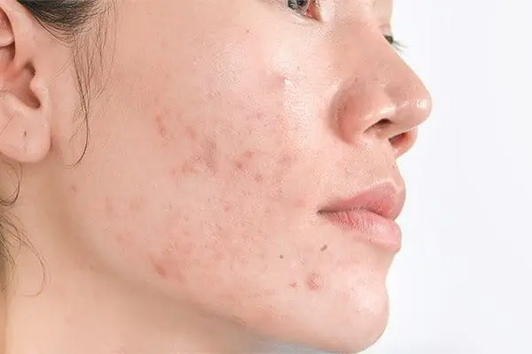 Teaser image illustrating post-inflammatory hyperpigmentation (PIH) with dark spots and uneven skin tone developing after inflammation or acne.