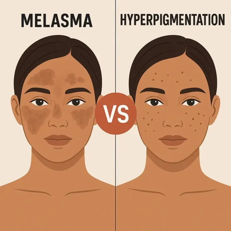 Illustrated comparison of melasma vs hyperpigmentation showing a woman with symmetrical brown melasma patches on one side of the face and scattered dark hyperpigmentation spots on the other side, separated by a VS label.