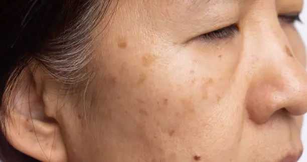Woman’s face with visible melasma patches showing symmetrical dark pigmentation on the cheeks.