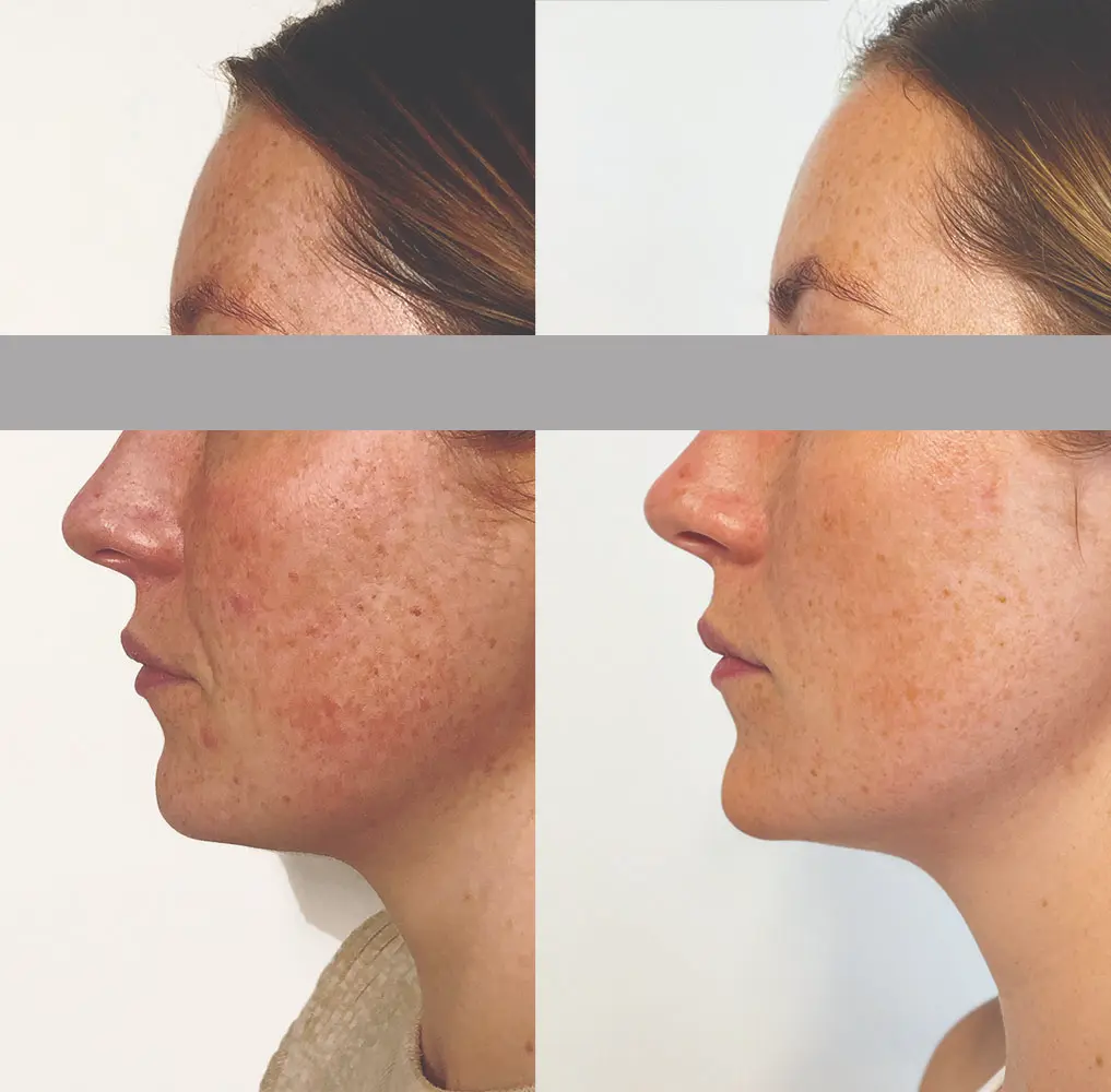 Before-and-after left-facing comparison showing visible improvement in facial skin tone and pigmentation after treatment, highlighting reduction in dark spots and uneven discoloration.