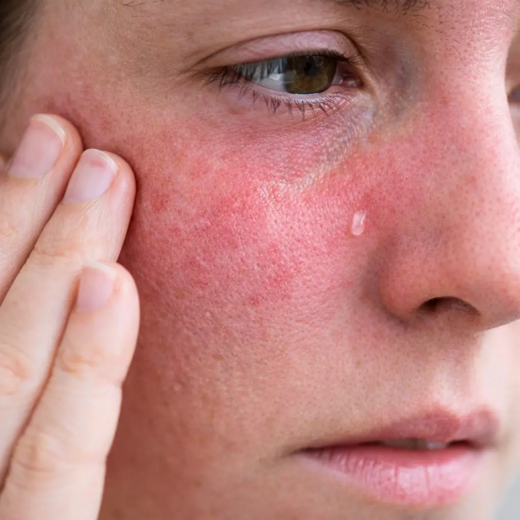 Close-up of facial skin showing redness, burning, and sensitivity around the cheek and eye area, a common symptom of skin barrier damage and inflammation.