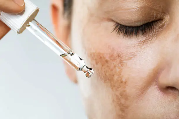 why melasma keeps coming back image