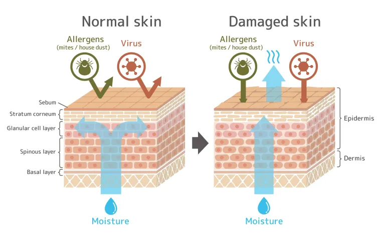 Skin barrier damage caused by overuse of harsh products