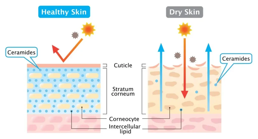 Dull skin appearance caused by barrier damage and dehydration