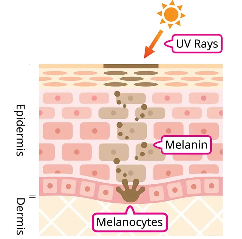 Hyperpigmentation-Diagram