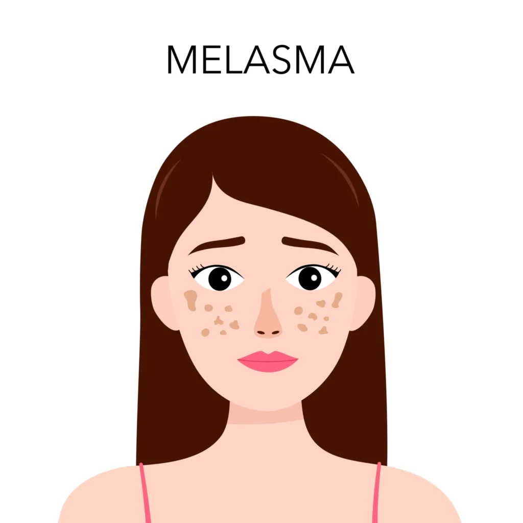 Melasma & Pigmentation