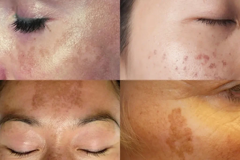 Visually reinforces the core problem — pigmentation returning after improvement