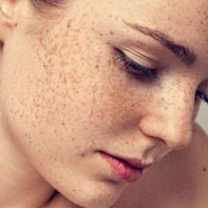 Why Pigmentation Is Harder to Treat in Pakistan