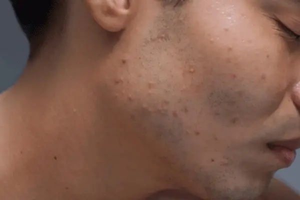 Signs-your-skin-is-over-exfoliated