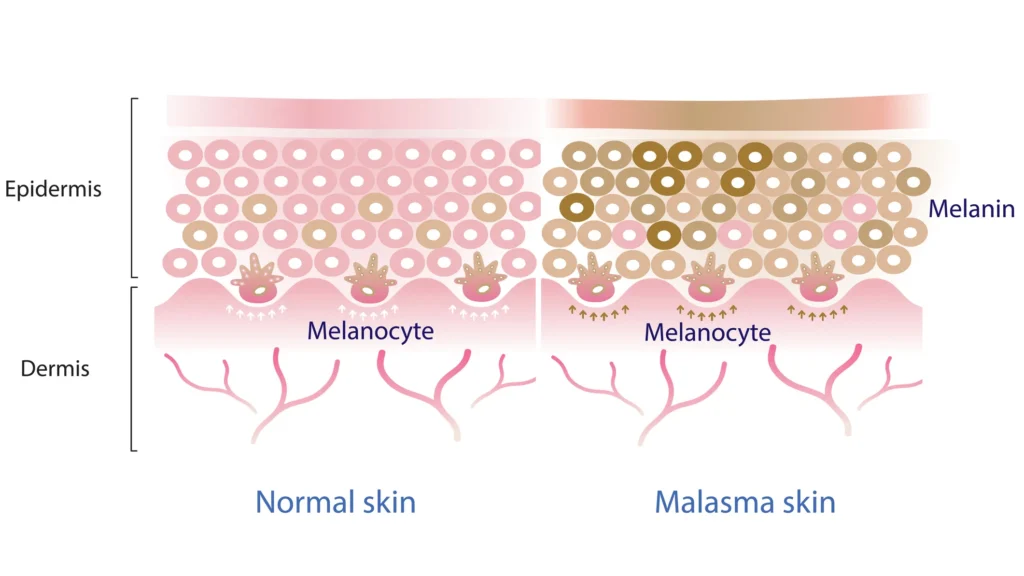 Why Pigmentation Is Harder to Treat in Pakistan 12