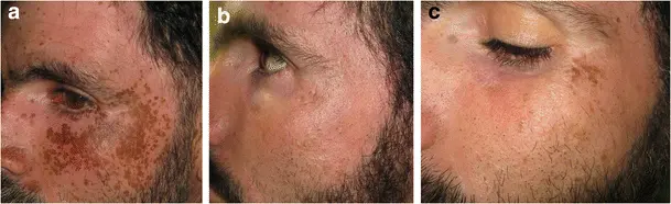a-Residual-pigmentation-on-face-b-Excellent-response-to-QS-laser-c-Mild-relapse-after