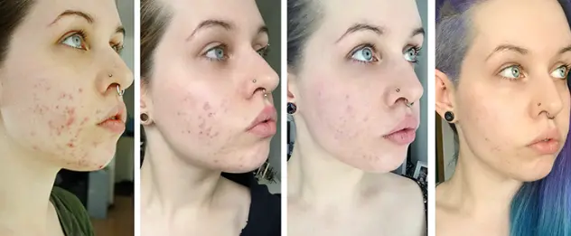 Illustration of a woman showing the progression of hyperpigmentation treatment over time, highlighting gradual reduction in dark spots and uneven skin tone with consistent care.