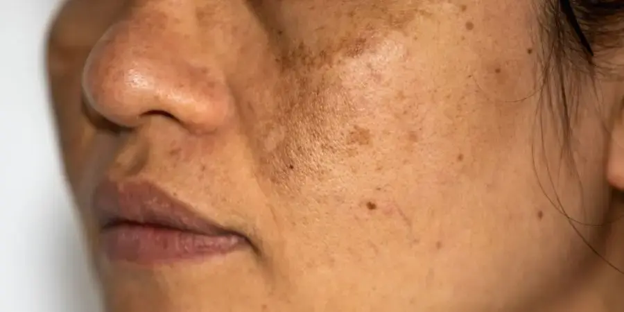 Difference between photodamage and pigmentation in skin layers image 3
