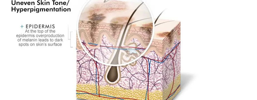skin-explained-uneven-skin-tone-hyperpigmentation