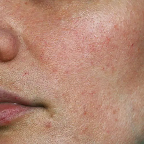 Dull skin appearance caused by barrier damage and dehydration 2, Why Your Skin Looks Dull Even Without Pigmentation
