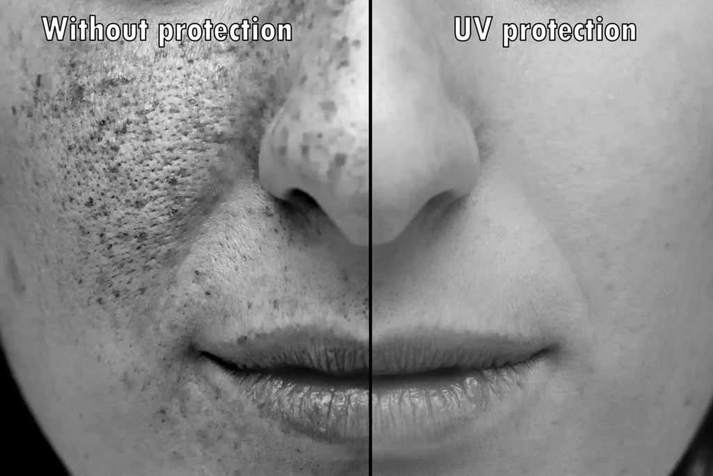 Photodamage causing dull skin before pigmentation appears