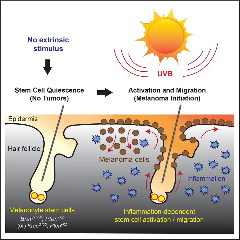 High UV exposure causing continuous melanocyte stimulation
