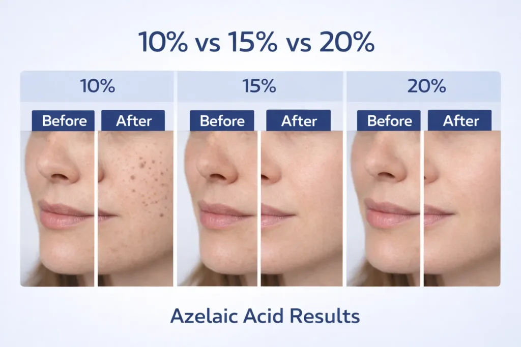 azelaic acid before and after pigmentation improvement melasma treatment results