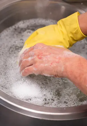 Hand exposed to detergent and water showing irritant contact dermatitis skin rash on hands