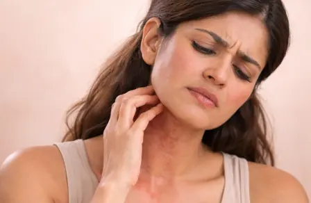 Woman scratching a red, inflamed neck rash caused by allergic contact dermatitis