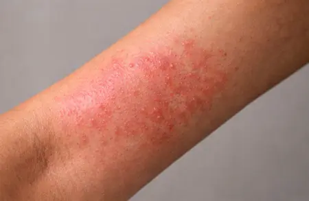 Detailed view of inflamed forearm with itchy skin rash and contact dermatitis symptoms