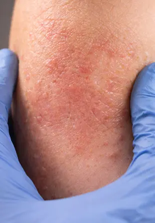 Close-up of dry, cracked inflamed skin illustrating irritant contact dermatitis symptoms and damaged skin barrier
