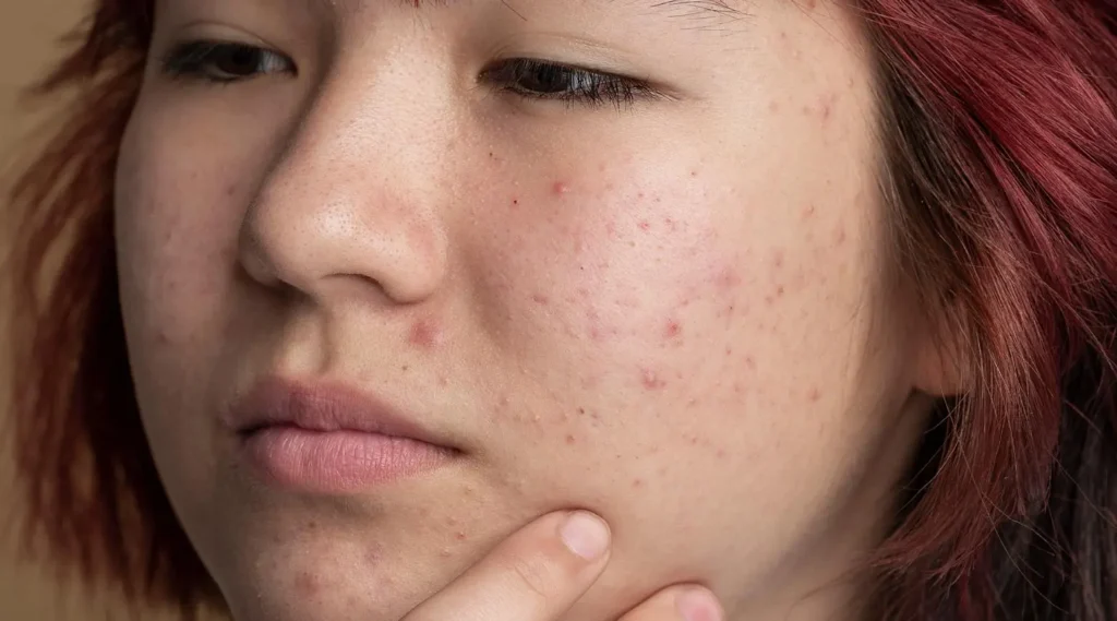 Acne on cheeks showing inflamed pimples caused by bacteria, clogged pores, and environmental exposure