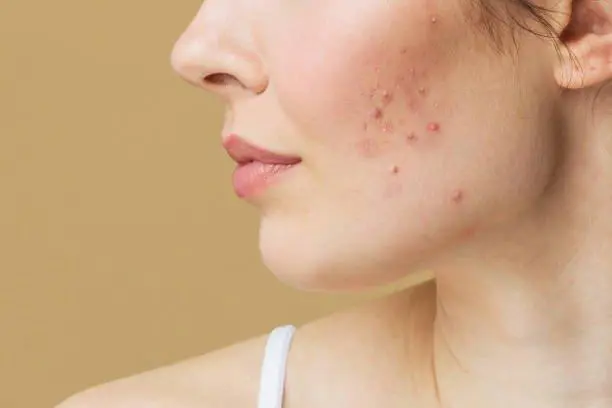 Acne on chin and jawline showing painful breakouts commonly linked to hormonal imbalance and clogged pores