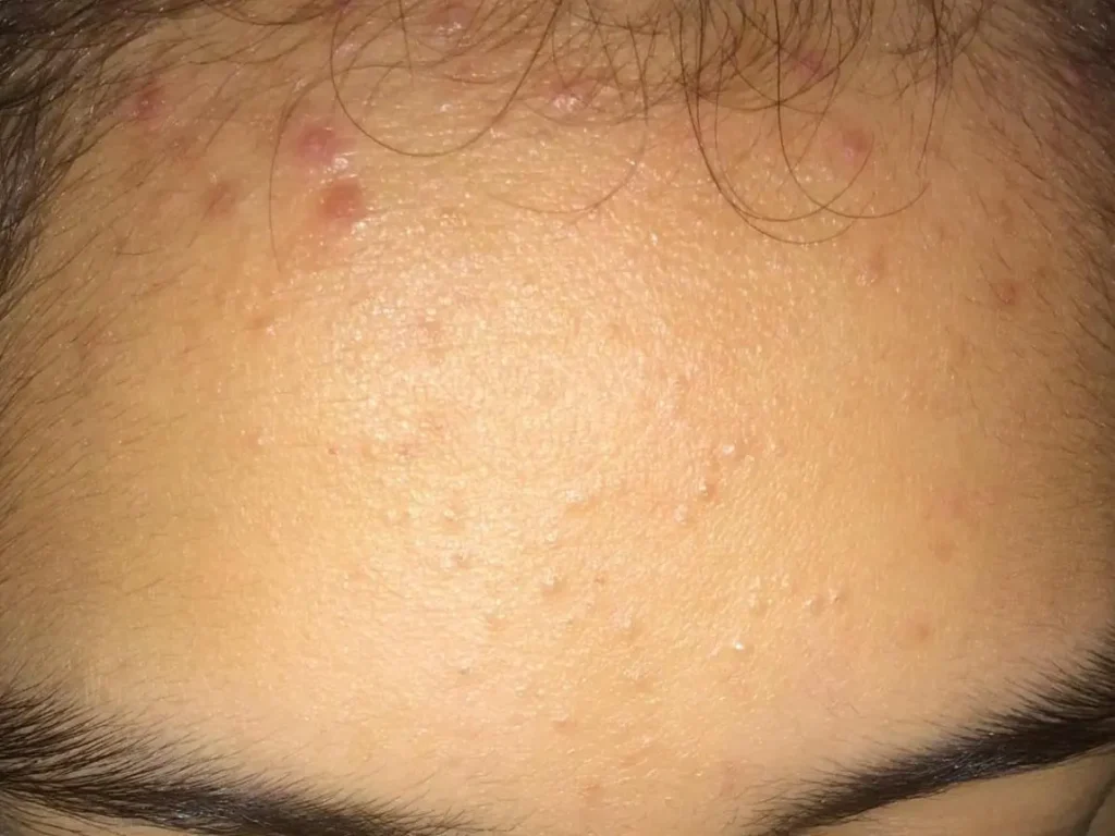 Forehead acne showing small bumps and pimples caused by excess oil production and clogged pores on the skin