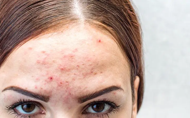 Forehead acne triggered by hair products, sweat, and oil buildup along the hairline causing breakouts