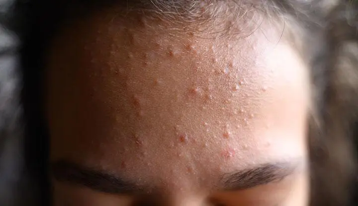 Common causes of forehead acne including oily skin, sweat, and product buildup leading to clogged pores