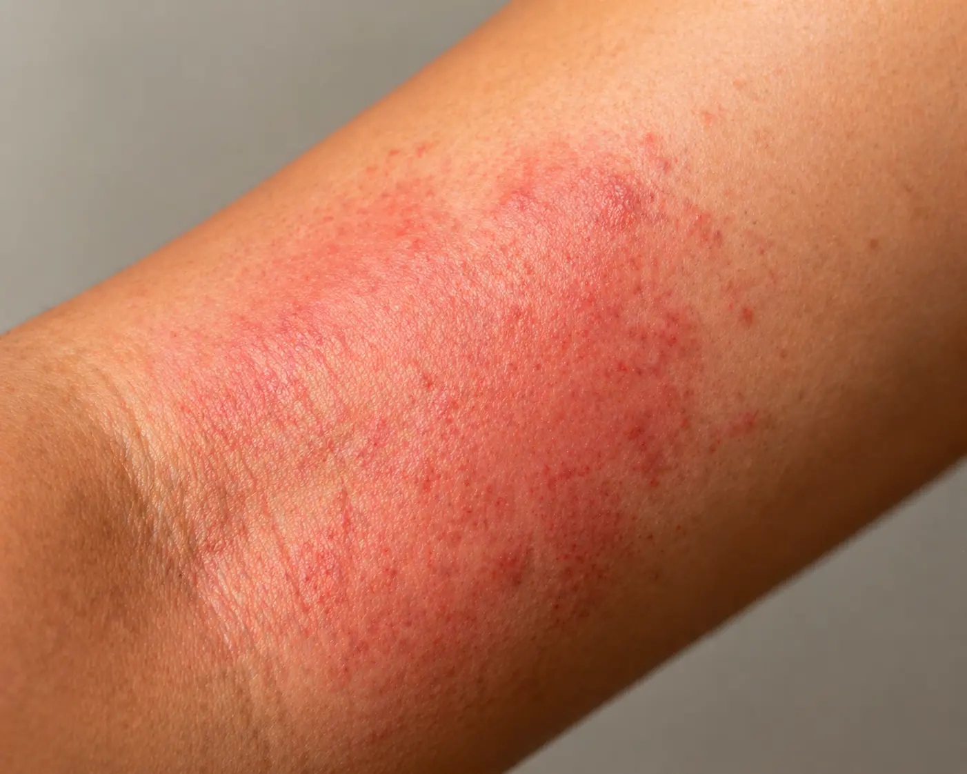 Close-up of a red, inflamed rash with small bumps on the forearm, showing a typical skin allergy rash