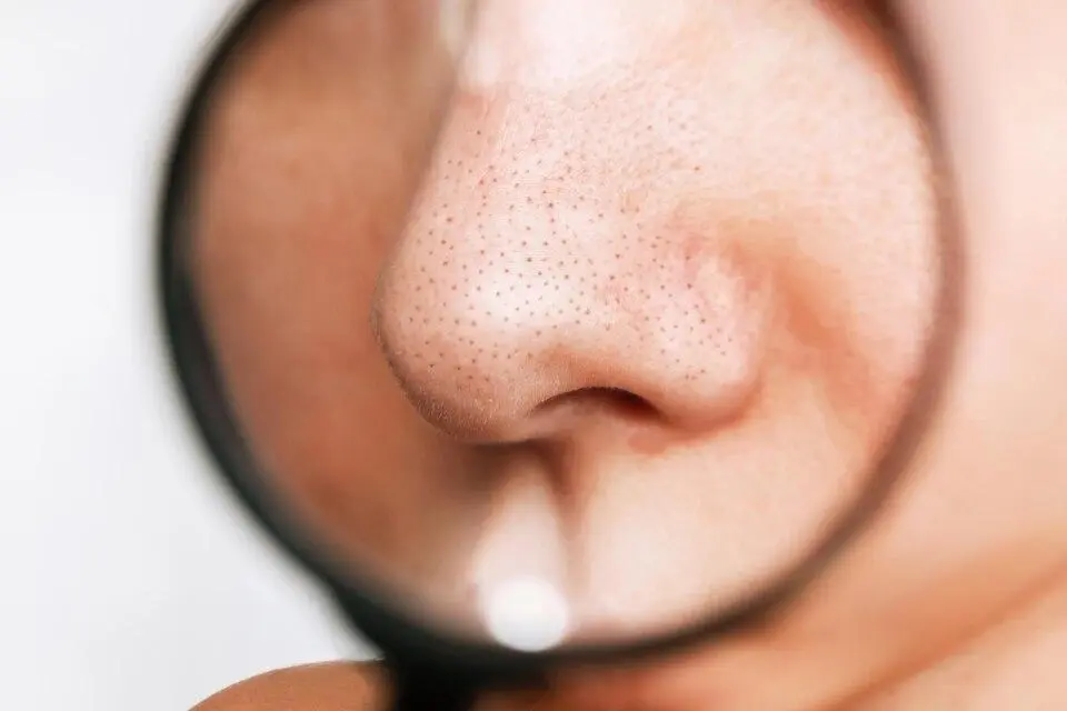 Acne on nose linked to high sebum production and enlarged pores leading to blackheads and breakouts