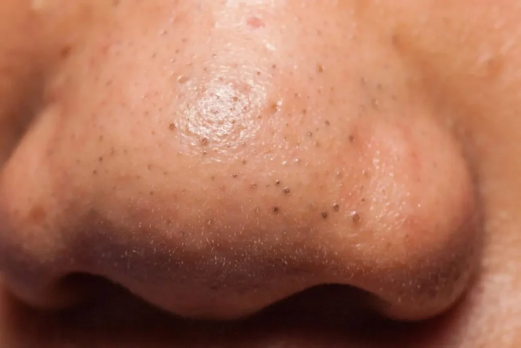 Nose acne showing blackheads and pimples caused by excess oil production and clogged pores on the nose